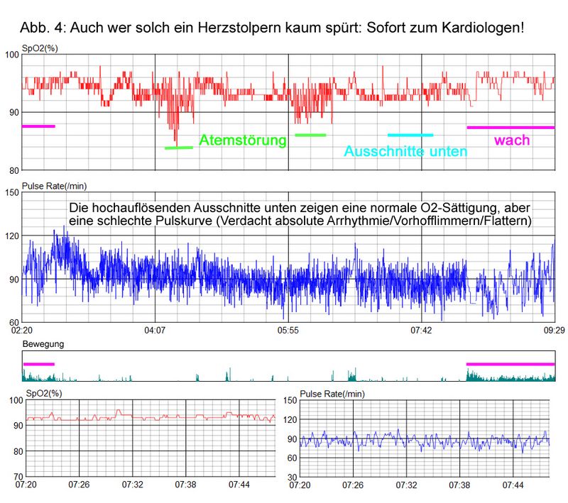 SpO2-Auswertung Checkme O2 - O2 Ring